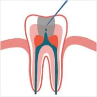根尖诱导成形术