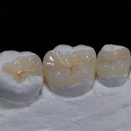 锂瓷嵌体（玻璃陶瓷）