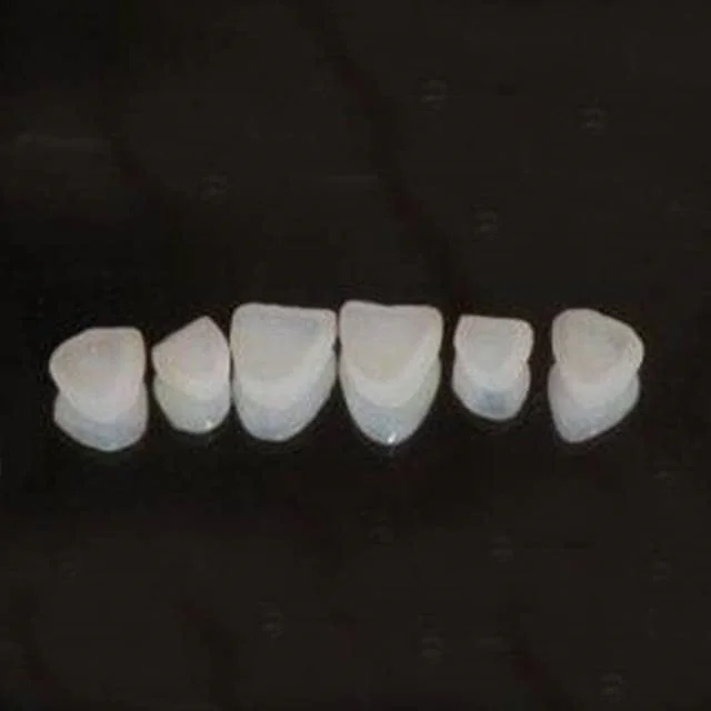 瑞士e.max press全瓷贴面