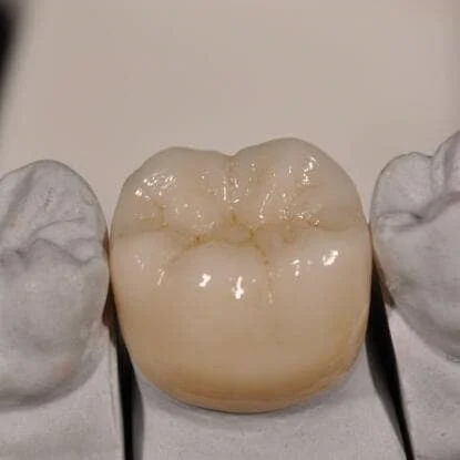 日本则武全瓷冠（渐变彩锆）