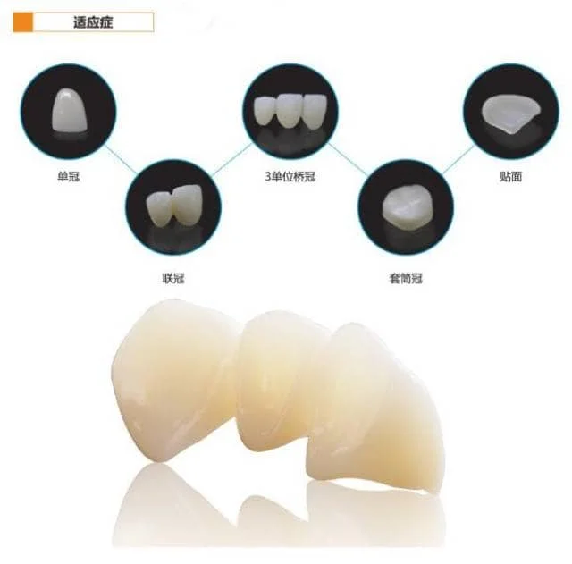 玉瓷TT全瓷冠（渐变彩锆）
