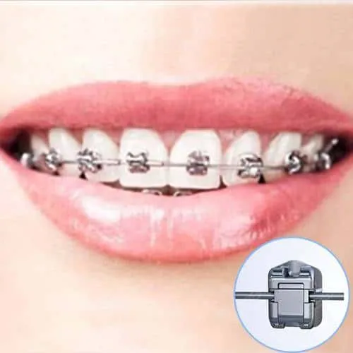 美国Ormco金属自锁托糟矫正