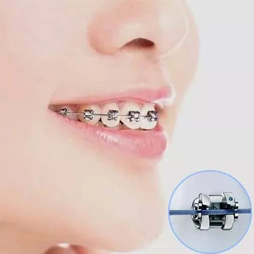 美国3M金属（自锁）托糟矫正