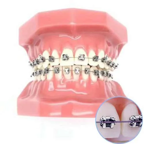 国产金属（自锁）托糟矫正