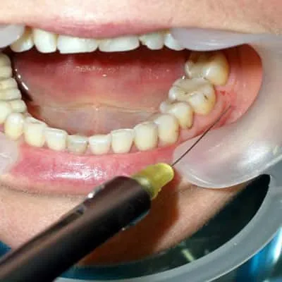 拔牙神经阻滞麻醉