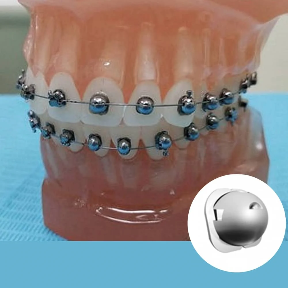 奈斯球型托槽矫正