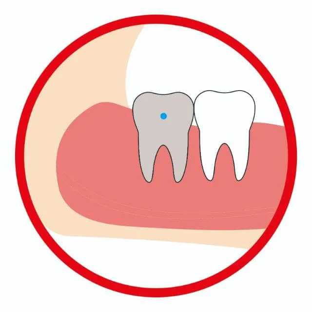 智齿垂直阻生（高位）