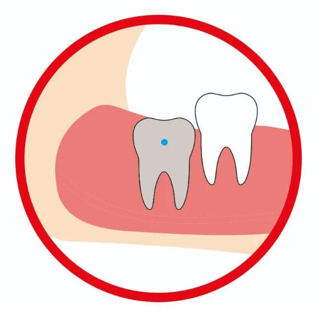 智齿垂直阻生（低位）