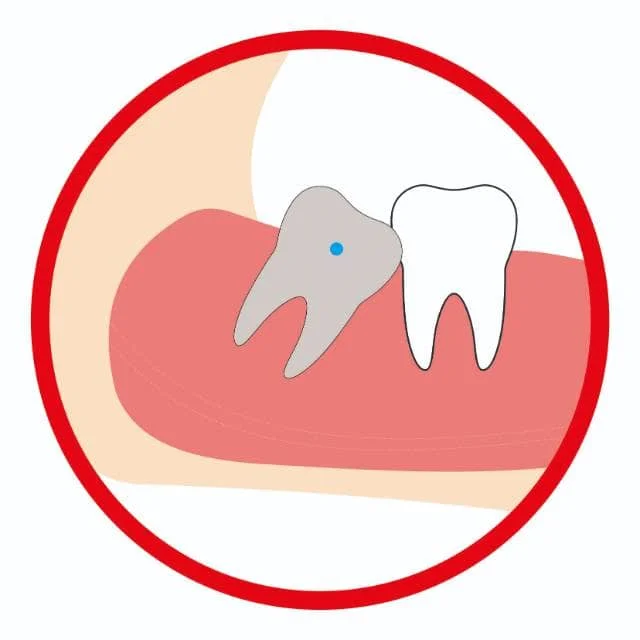 智齿近中阻生（高位）