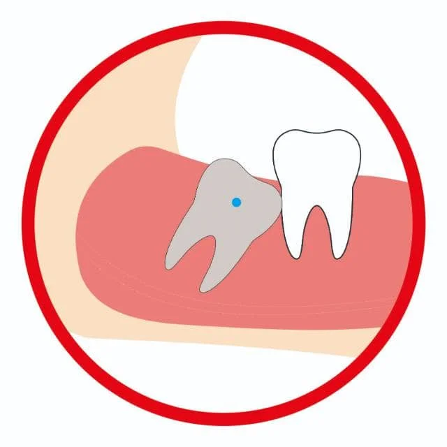 智齿近中阻生（低位）