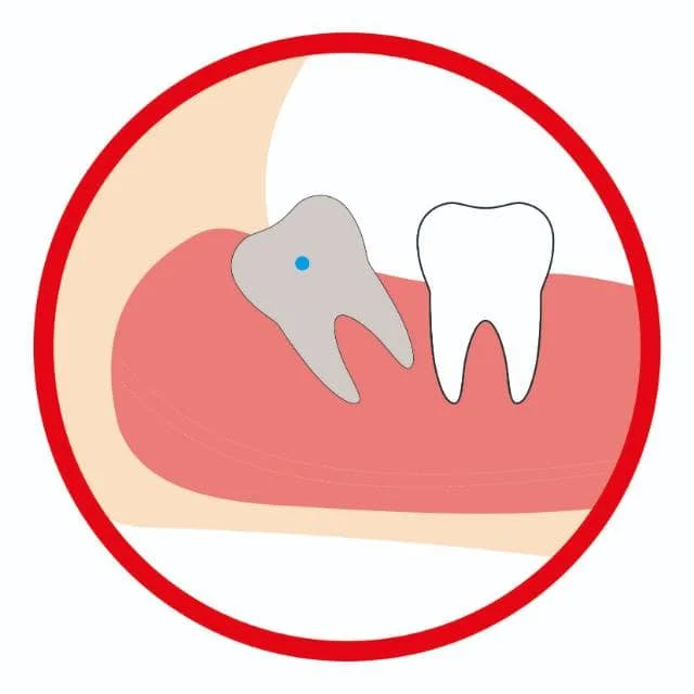 智齿远中阻生（高位）