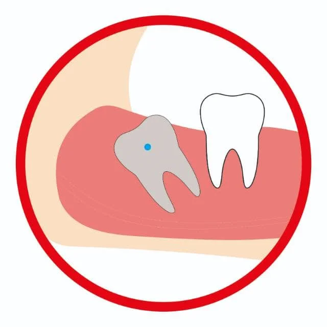 智齿远中阻生（低位）