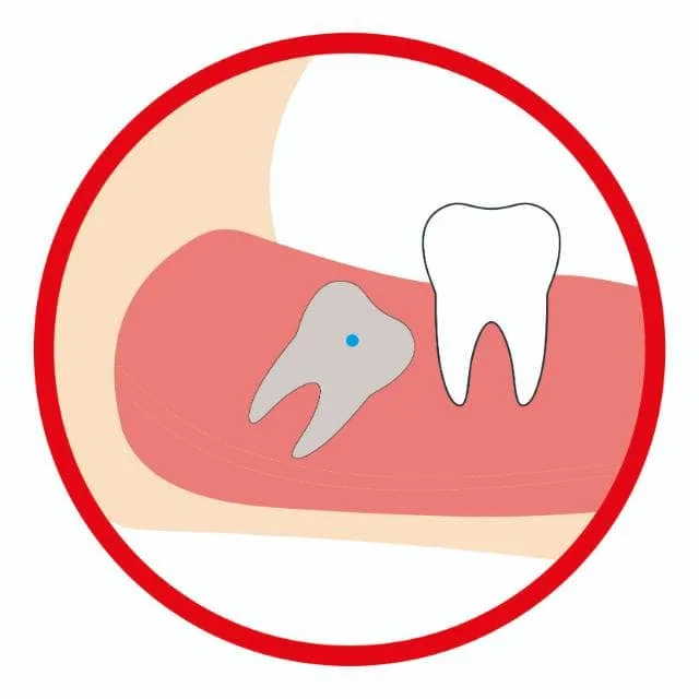 埋伏牙（复杂）