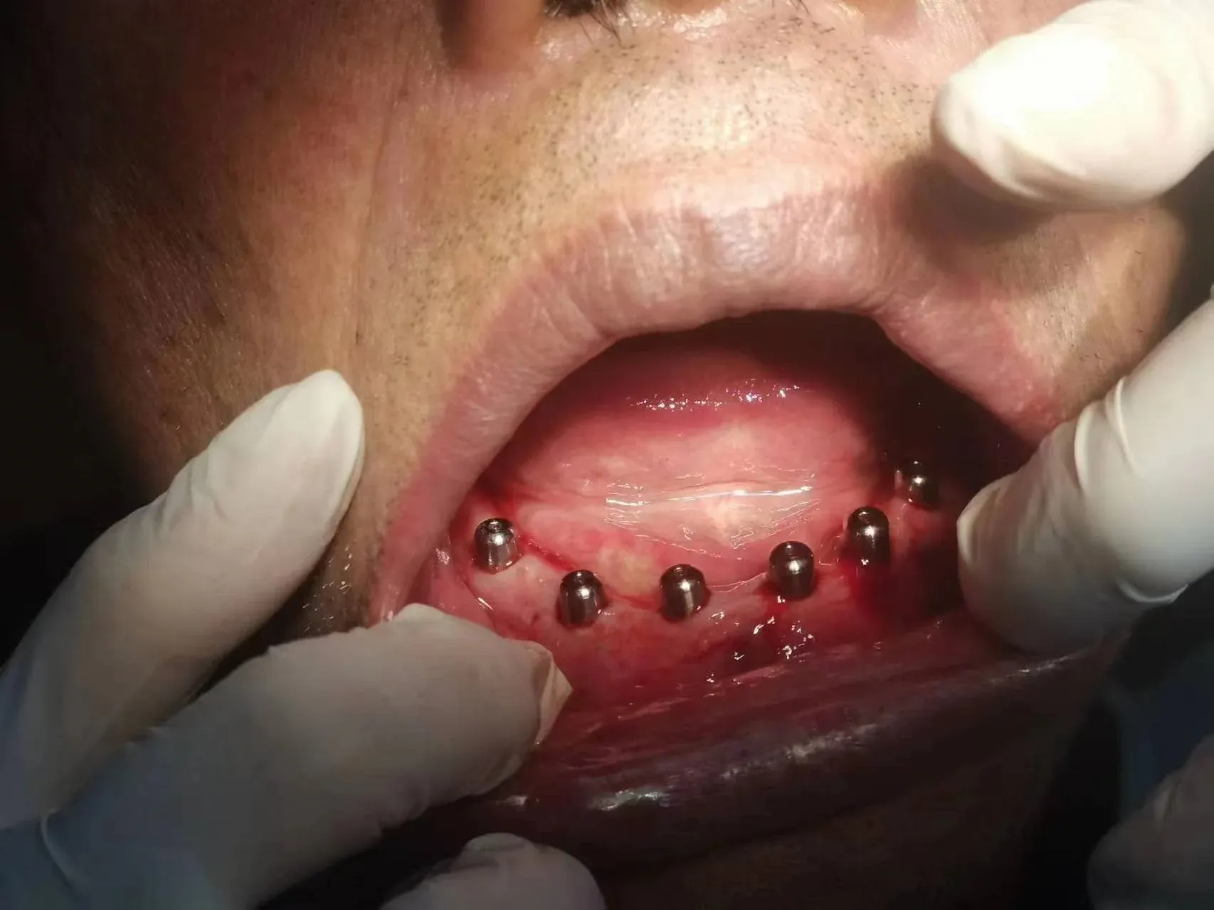 数字化导板技术 - 图片 3