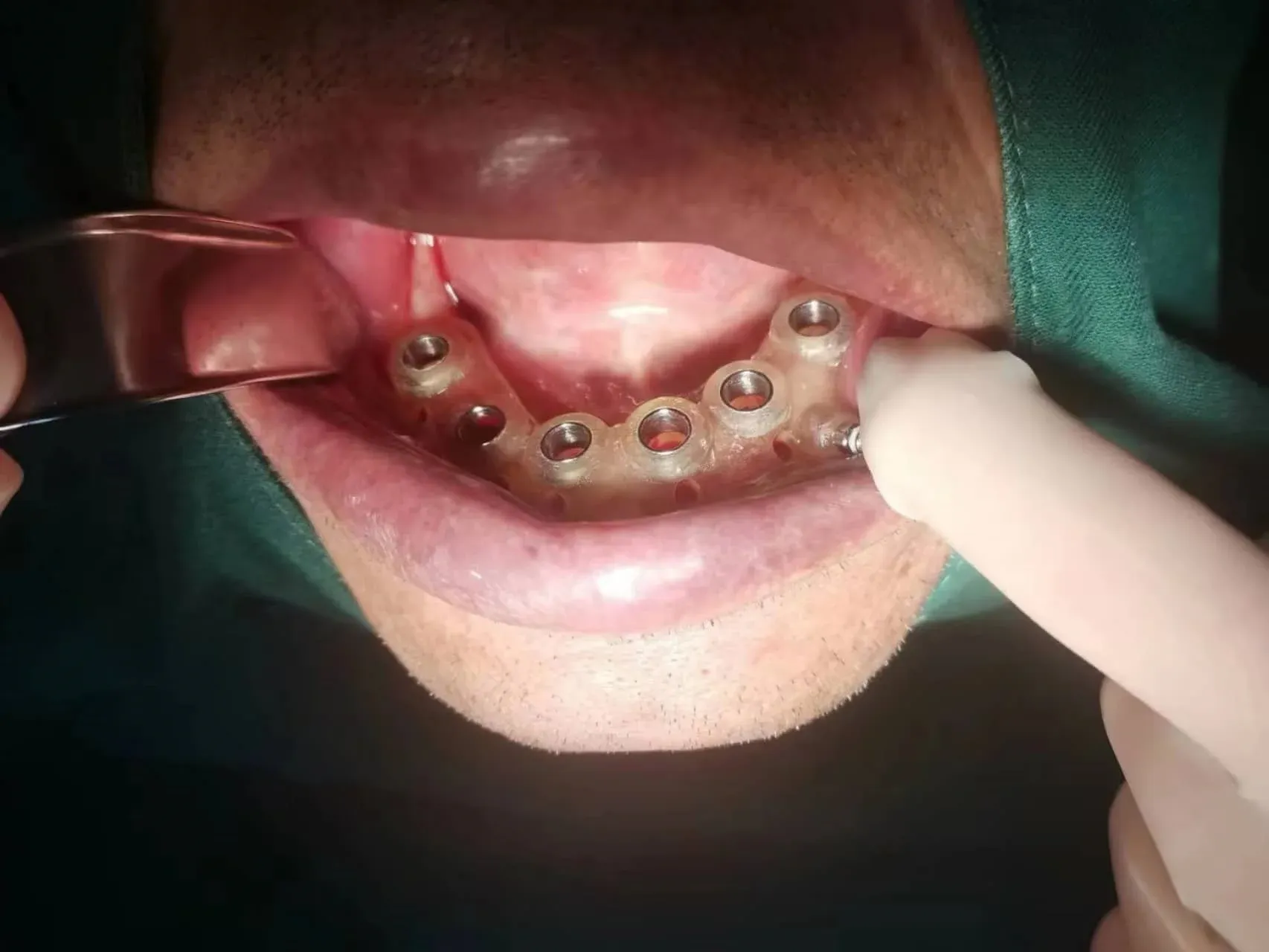 数字化导板技术 - 图片 4