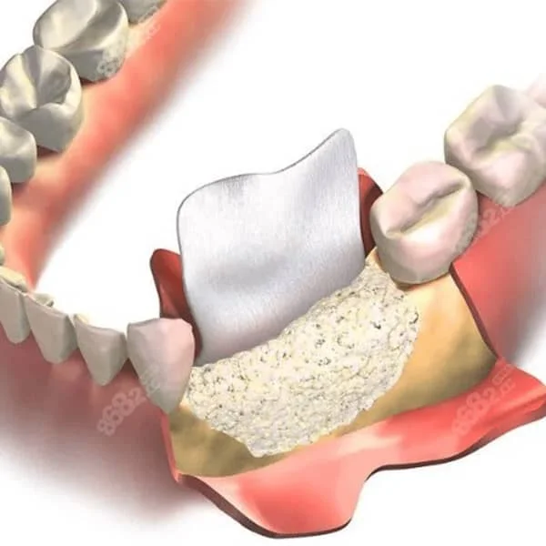骨劈开+骨粉骨膜