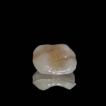 国产氧化锆嵌体