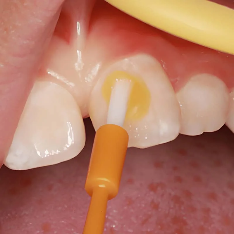 儿童全口涂氟防龋（泡沫）