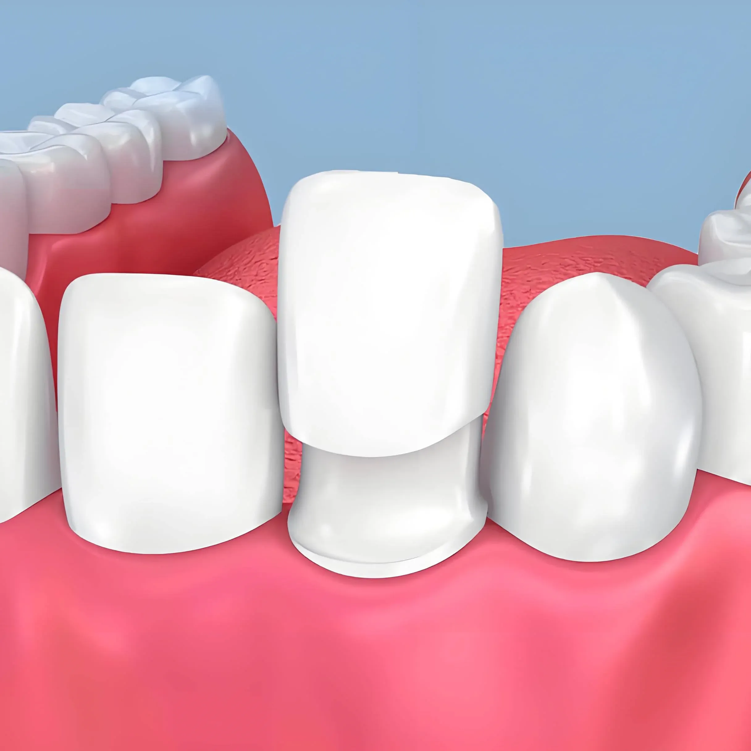 美国3M LAVA超薄瓷贴面 - 图片 2