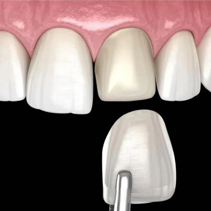 美国3M LAVA超薄瓷贴面 - 图片 3