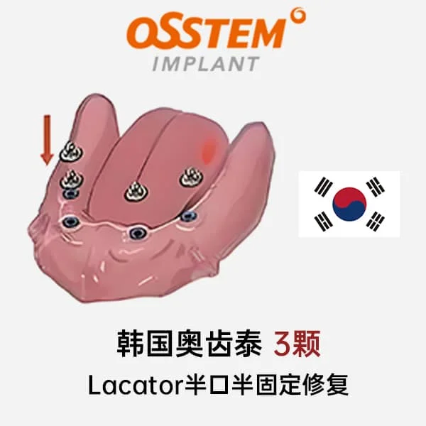 奥齿泰3颗Lacator半口半固定修复