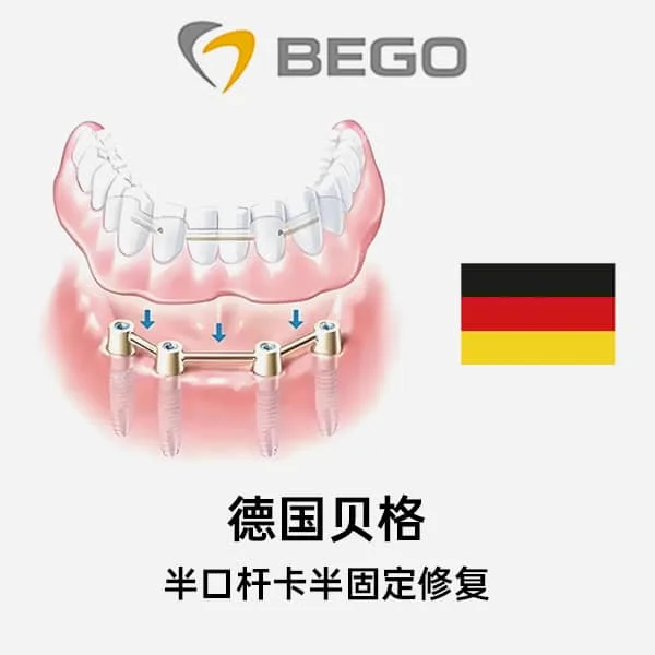 德国贝格半口杆卡半固定修复