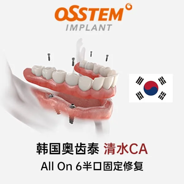 韩国奥齿泰CA清水All On 6半口固定修复