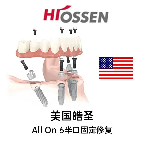 美国皓圣All On 6半口固定修复