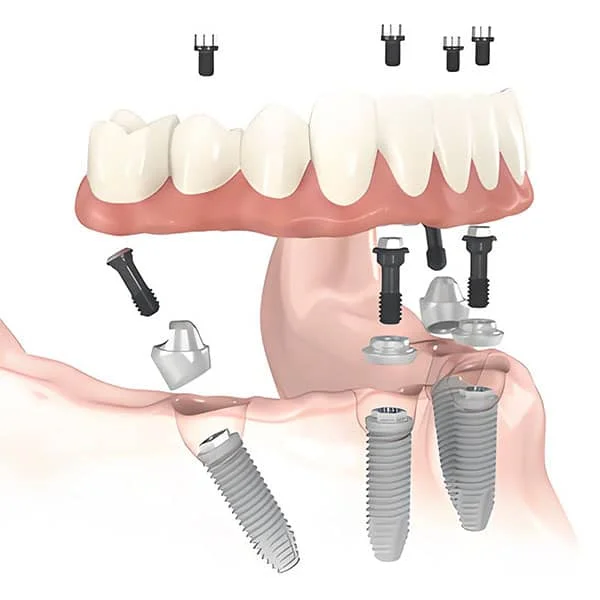 All on 4/6固定修复