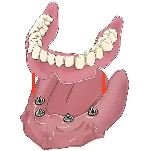 Lacator半固定修复