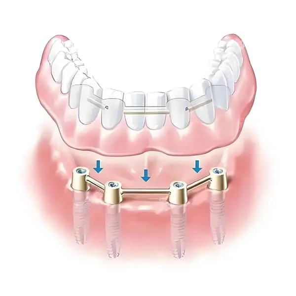 杆卡半固定修复